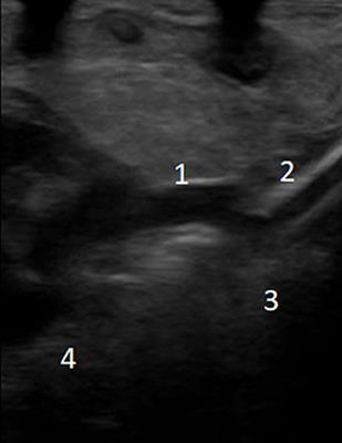 Successful Extracorporeal Membrane Oxygenation After Incidental Azygos Vein Cannulation in a Neonate With Right-Sided Congenital Diaphragmatic Hernia Interruption of the Inferior Vena Cava and Azygos Continuation